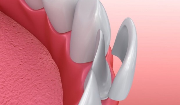 faccette dentali