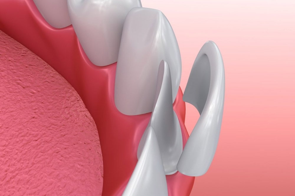 Cosa sono le faccette dentali? Cosa sono le faccette dentali?